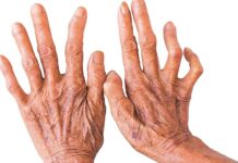 पाल्पामा छ महिनामा थपिए सात कुष्ठरोगी