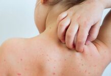 मलङ्गवामा दादुरा सङ्क्रमण फैलियो