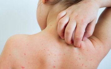 मलङ्गवामा दादुरा सङ्क्रमण फैलियो