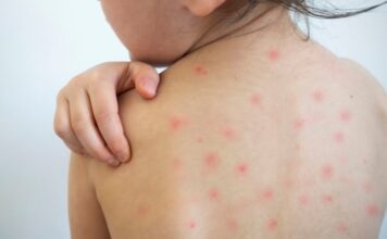 ढोरपाटनमा अझै नियन्त्रणमा आएन दादुरा सङ्क्रमण