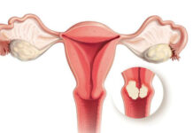 ‘पाठेघर खस्ने समस्या भएका बिरामी अझै उपचार गर्न अस्वीकार गर्दछन्’