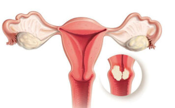 ‘पाठेघर खस्ने समस्या भएका बिरामी अझै उपचार गर्न अस्वीकार गर्दछन्’
