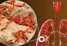 विश्व क्षयरोग दिवसः जनचेतनामूलक कार्यक्रम गरी मनाइँदै