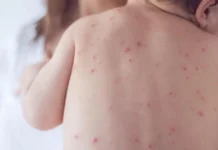 दादुराका ६७ बिरामी उपचारपछि घर फर्के, २० जनाको ‘आइसोलेसन’ उपचार जारी